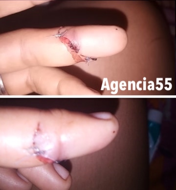 MP de Acapetahua, de la Fiscalía General del Estado de Chiapas, dilata querella de Violencia Feminicida, la mujer casi pierde un dedo en la agresión